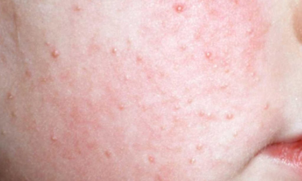 Actinic Keratosis