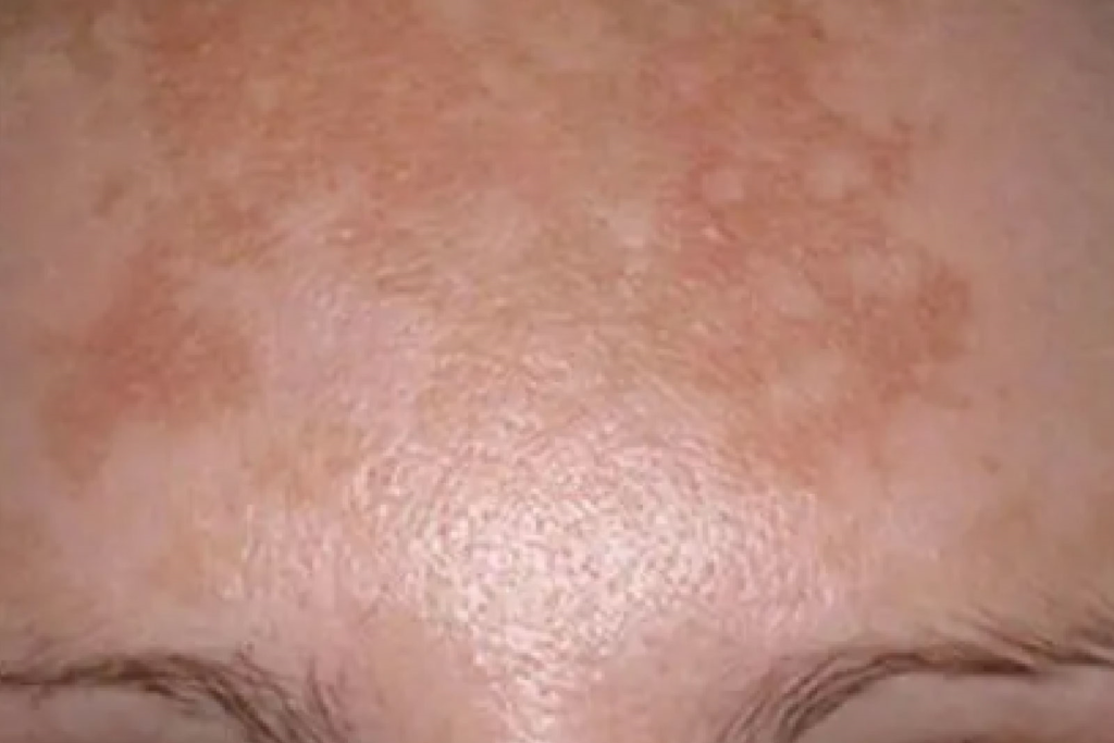 Melasma