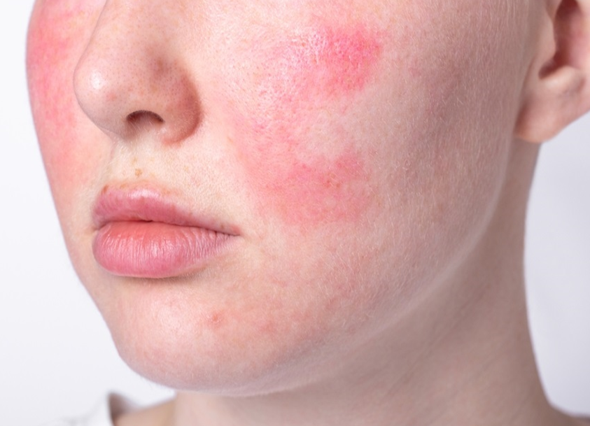 Rosacea